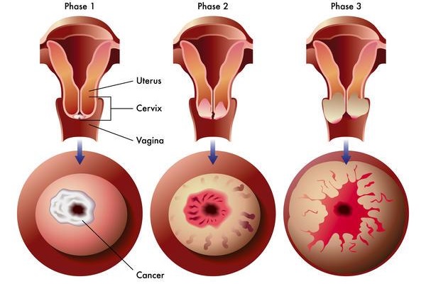 viêm cổ tử cung là gì