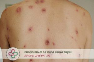 bệnh giang mai ở nữ