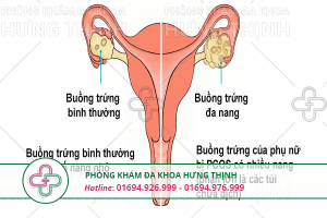 Buồng trứng đa nang