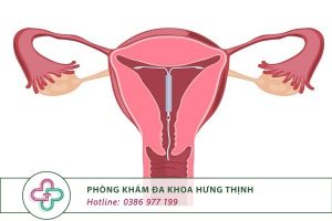 đặt vòng tránh thai