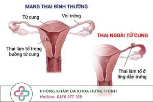 mang thai ngoài tử cung