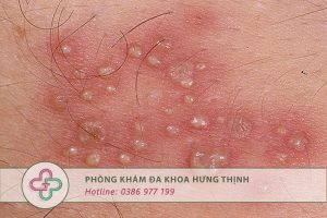 mụn rộp sinh dục nữ
