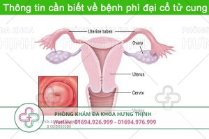 Phì đại cổ tử cung là gì