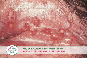 Triệu chứng bệnh lậu ở nữ giới