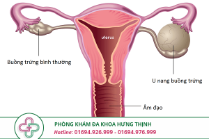U nang buồng trứng