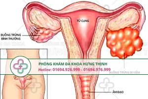 Viêm buồng trứng