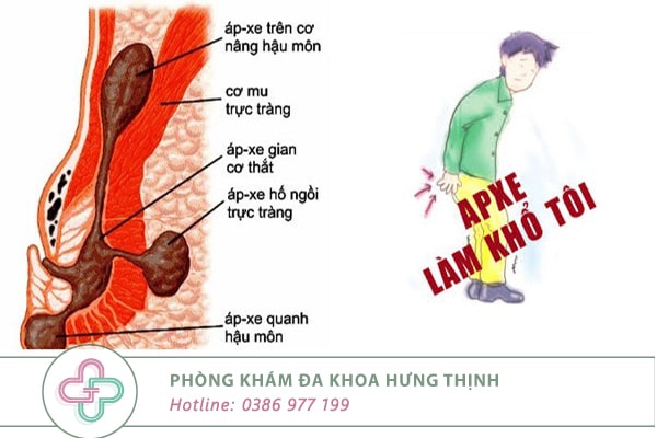 Áp xe hậu môn – Nguyên nhân, triệu chứng và cách điều trị