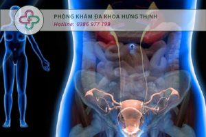 điều trị viêm vùng chậu