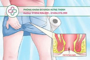 nứt kẽ hậu môn