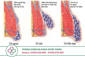 Trĩ hỗn hợp