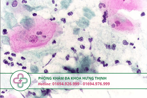 Viêm âm đạo do trùng roi