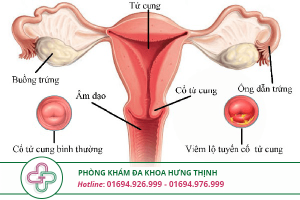 bệnh viêm lộ tuyến cổ tử cung