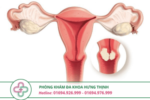 polyp tử cung khi mang thai
