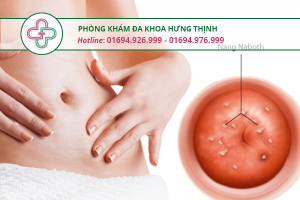u nang cổ tử cung