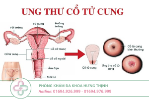 điều trị ung thư tử cung