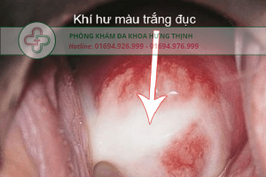 khí hư đặc quánh