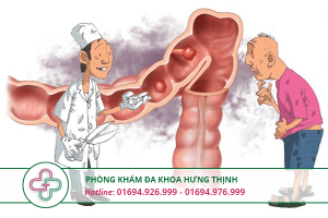 nguyên nhân gây rò hậu môn
