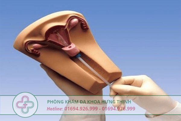 Những quan niệm sai lầm về vòng tránh thai