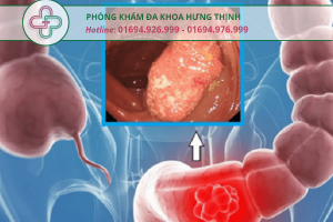 ung thư trực tràng