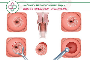 viêm cổ tử cung nhẹ