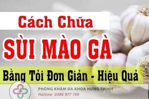chữa sùi mào gà bằng tỏi