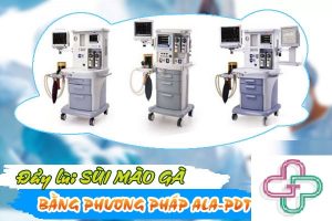 điều trị sùi mào gà bằng phương pháp ala-pdt