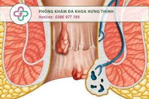 hoại tử hậu môn
