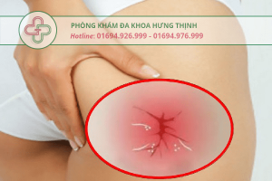 viêm nhiễm hậu môn ở nữ