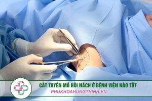 Cắt tuyến mồ hôi nách ở bệnh viện nào tốt